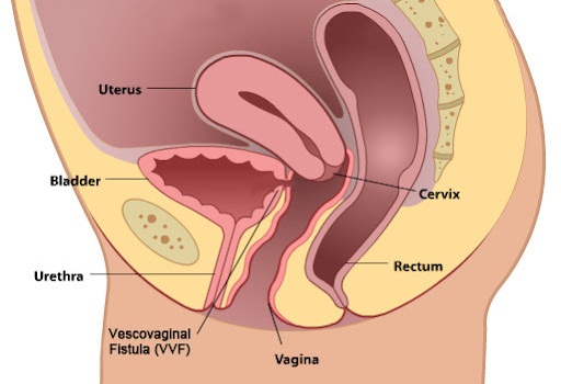 Ureteric & Bladder Fistula